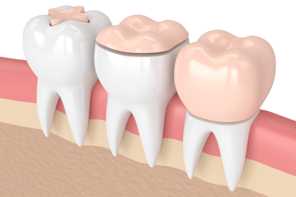 Inlays prothèse dentaire sur mesure dentiste Roanne