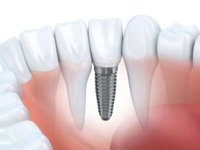 Dents manquantes implant dentaire Roanne