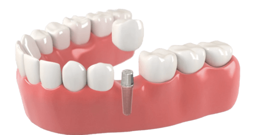 Implants dentaire cabinet dentiste D2L