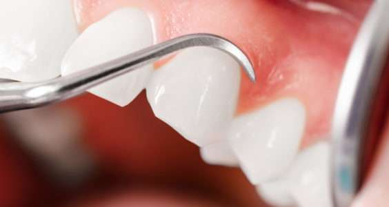 Intervention soin gencives cabinet dentaires Roanne