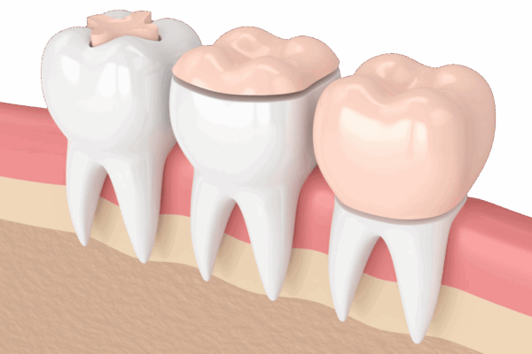 Inlays-Onlays-Couronne-cabinet-dentaire-roanne-D2L-1